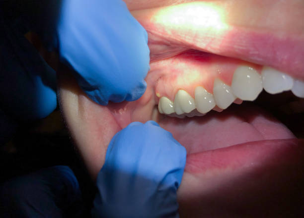 Best Emergency Dentist for Lost Fillings or Crowns in Adamsville, AL